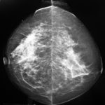 Asimetría_de_la_densidad-_Mamografía